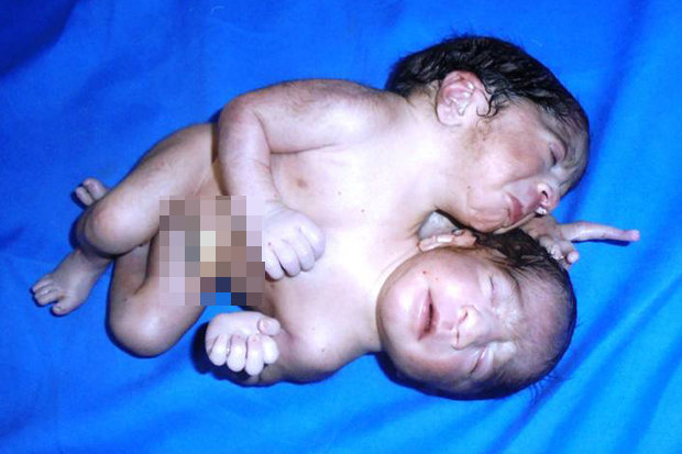 В Индии родился двухголовый младенец