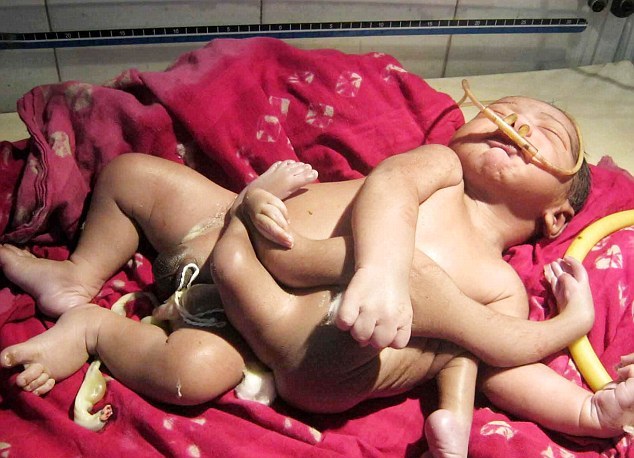 В Индии родился ребенок с остатками близнеца на животе