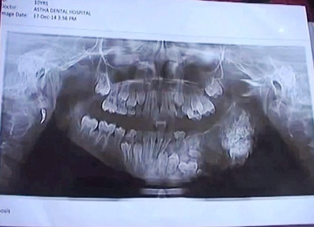 В Индии семилетнему мальчику удалили 80 лишних зубов