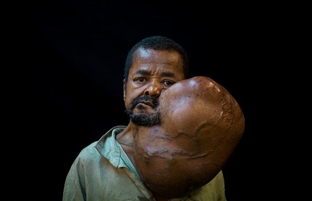 Жителю Мадагаскара удалили 7-килограммовую опухоль