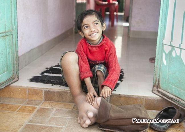Индийский мальчик с огромной ногой поставил врачей в тупик