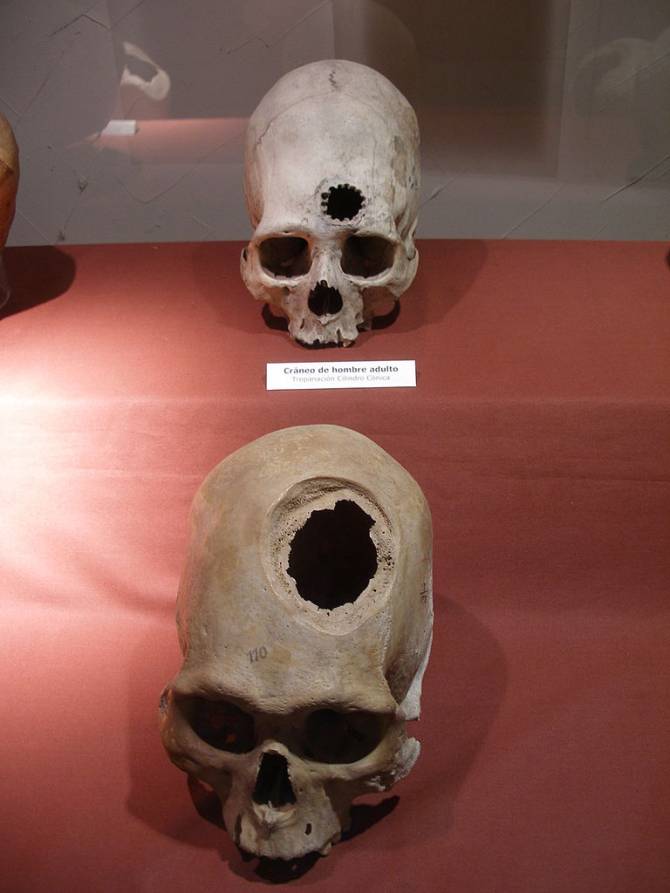 Древняя сибирская практика трепанации черепа