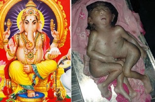 В Индии родился ребенок с одной головой, 4 руками и 4 ногами