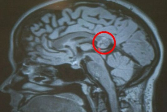 В головном мозге девушки нашли недоразвитый эмбрион ее близнеца