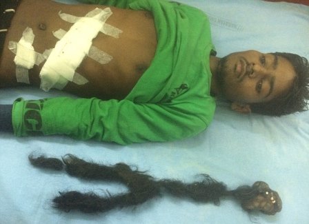 В теле индийца нашли опухоль-паразит с волосами и зубами