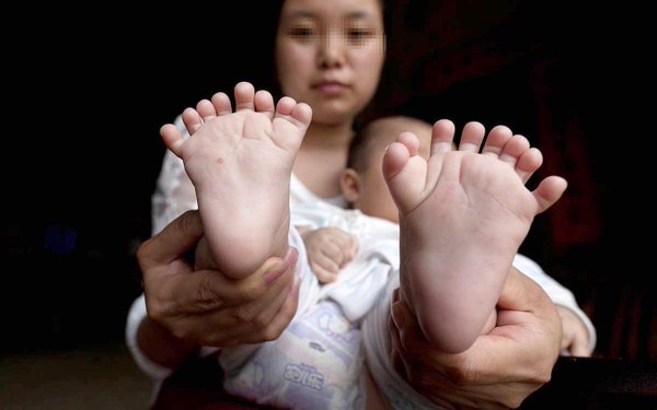 У трехмесячного китайского мальчика 15 пальцев на руках и 16 на ногах