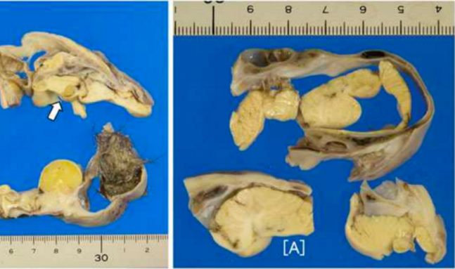 Уникальная аномалия: Японские хирурги обнаружили крошечный мозг внутри опухоли яичника