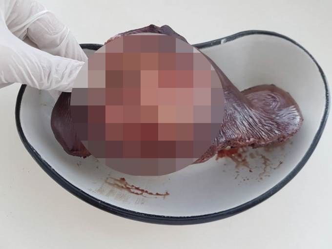 Хирурги удалили из печени жителя Красноярска огромный узел червя-паразита