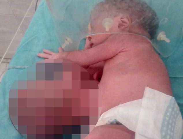 Уникальный случай: В Индии родился младенец с второй головой, растущей из правого бока