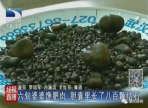 Китайские хирурги извлекли из пациентки 806 желчных камней 