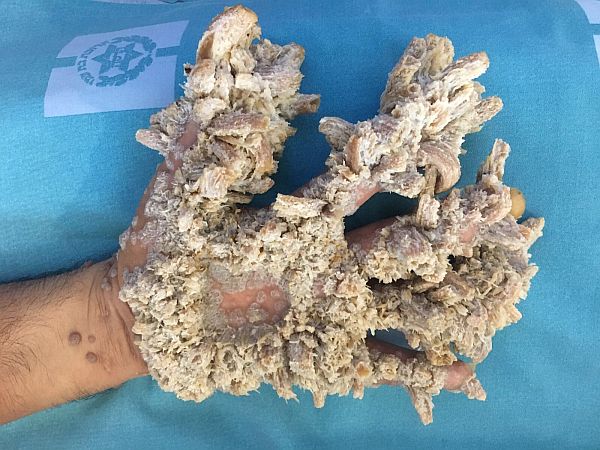 В Израиле врачи вылечили местного "человека-дерево" удалив наросты вместе с кожей 