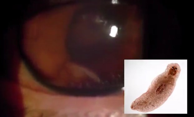 Из глаза мексиканского подростка удалили толстого червя (Осторожно, шокирующий контент 18+) 
