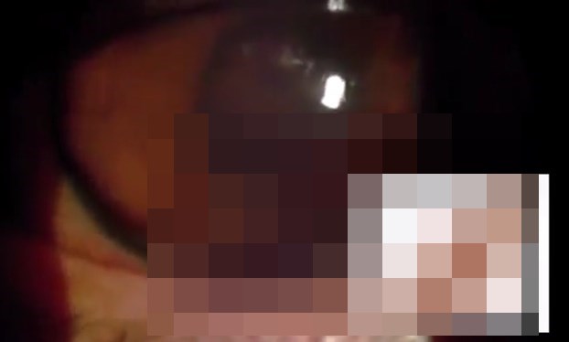 Из глаза мексиканского подростка удалили толстого червя (Осторожно, шокирующий контент 18+)