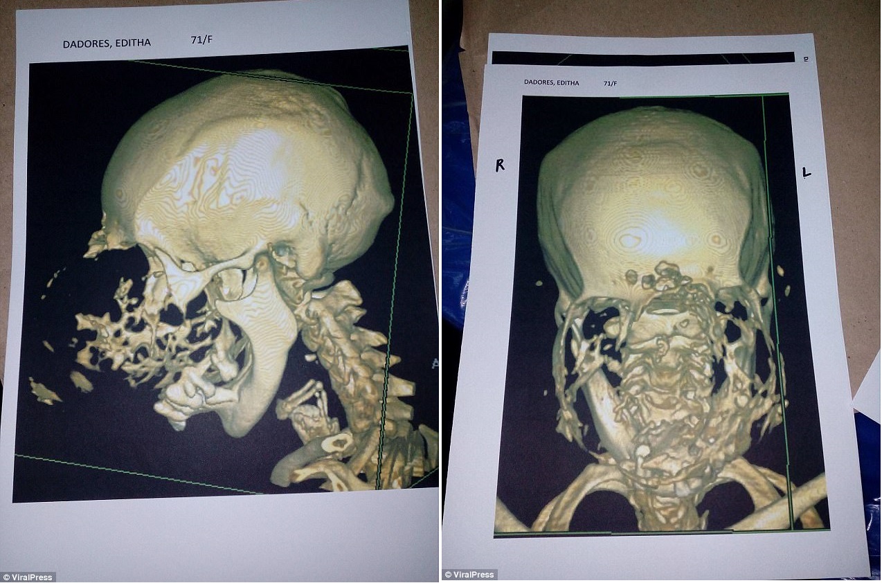 Страшная опухоль раскрошила женщине всю лицевую часть черепа 