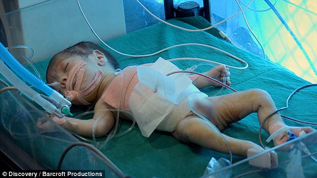 В Индии родился мальчик с приросшим к животу близнецом-паразитом 