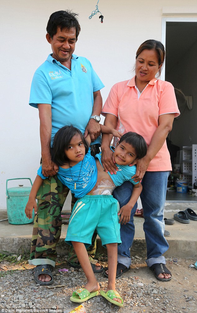У 7-летних сиамских близнецов из Таиланда одна на двоих нижняя часть тела 