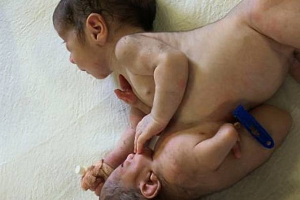 В Индии родился мальчик с приросшим к животу близнецом-паразитом