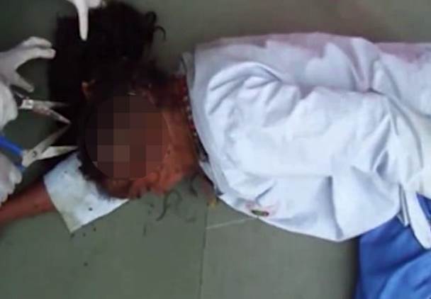 В Индии спасли женщину, чью голову заживо поедали личинки (Осторожно, шокирующий контент! 18+)