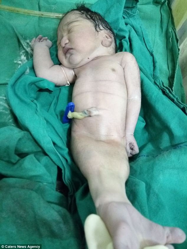 В Индии родился младенец-русалка 