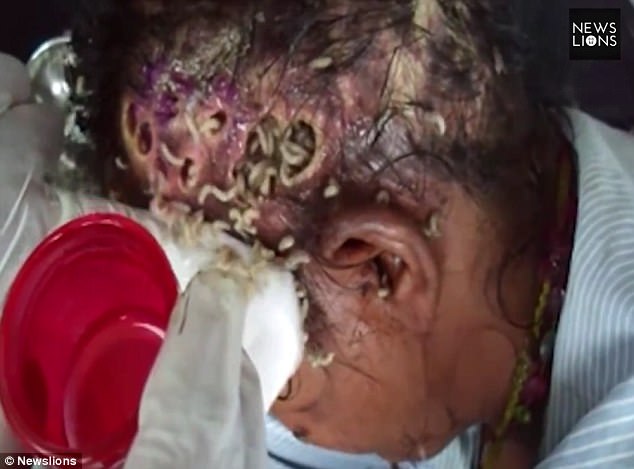 В Индии спасли женщину, чью голову заживо поедали личинки (Осторожно, шокирующий контент! 18+) 