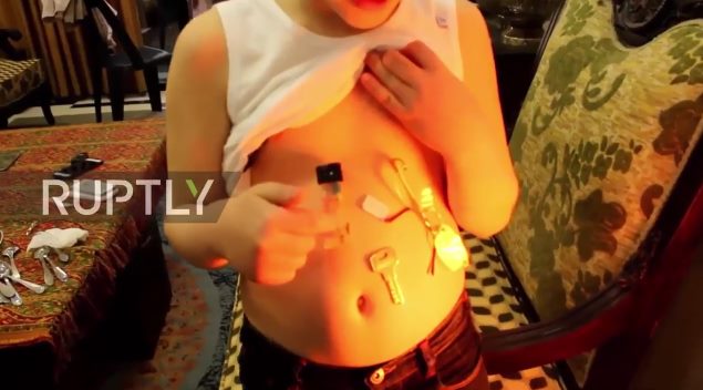Опекуны сирийского мальчика-магнита просят российских ученых о помощи 