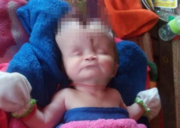 Младенец родился с раскрытым и деформированным черепом и до сих пор жив