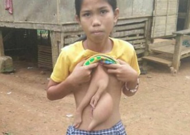 На Филиппинах 14-летняя школьница живет с частями тела близнеца-паразита, растущими из живота