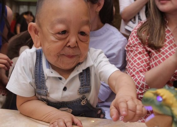 В Казахстане живет мальчик - старик с редким синдромом вялой кожи