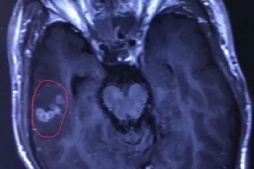 В Китае из мозга пациента вытащили живого 10-сантиметрового червя