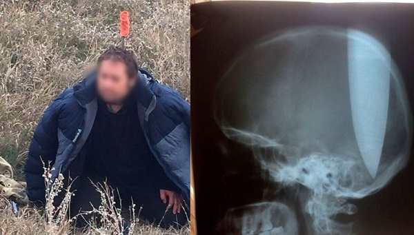 В Ростовской области мужчина пронзил себе голову огромным ножом и... практически не заметил разницы