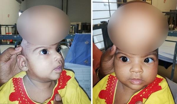 В Пакистане девочка родилась с мозгом вне головы и выжила