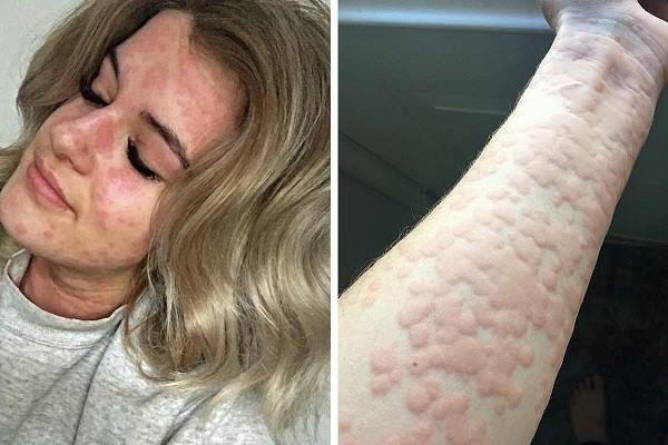 Жительница Канады страдает очень редкой аллергией на зиму