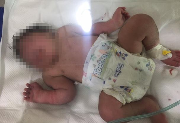 В Ираке родился ребенок с микроцефалией и без носа