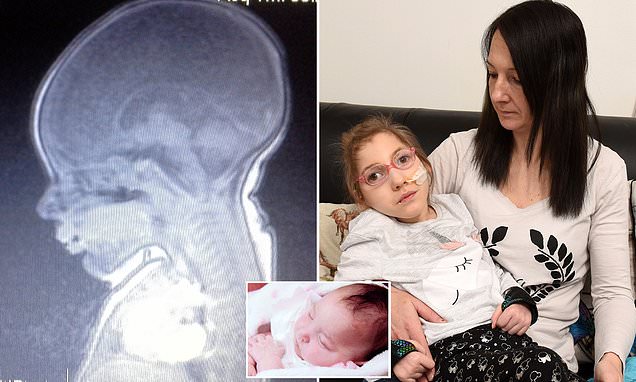 Девочке, родившейся без мозга, исполнилось 6 лет