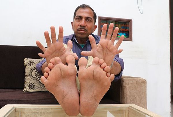 У индийца рекордные 28 пальцев на руках и ногах