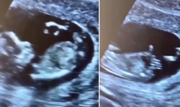 На УЗИ увидели танцующего в утробе младенца и дерущихся близнецов