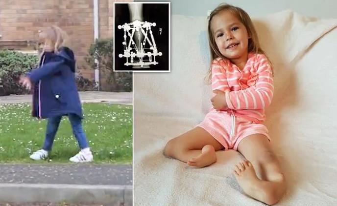 Девочка, рожденная с вывернутыми ногами, теперь может ходить как обычные люди