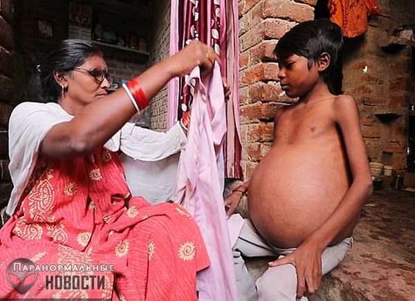 У жителя Индии без остановки растет желудок