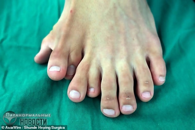 В Китае прооперировали мужчину с 9 пальцами на ноге