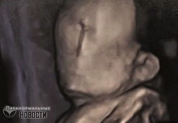 В Португалии родился младенец без лица