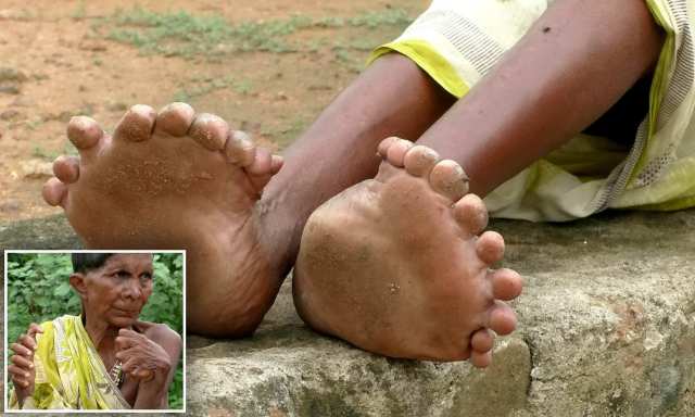 У 63-летней индианки 19 пальцев на ногах и 12 на руках