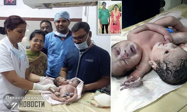В Индии родился ребенок с 2 головами и 3 руками