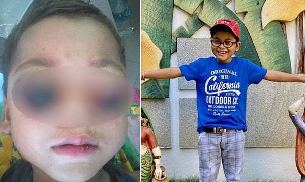 Медицинское чудо в Индии: Мальчика, чьи глаза из-за рака вылезли из орбит, вылечили и теперь он снова может видеть