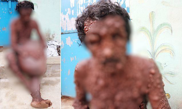 Индиец по прозвищу «человек-бородавка» покрыт мелкими опухолями с ног до головы (Осторожно! Шокирующий контент 18+)