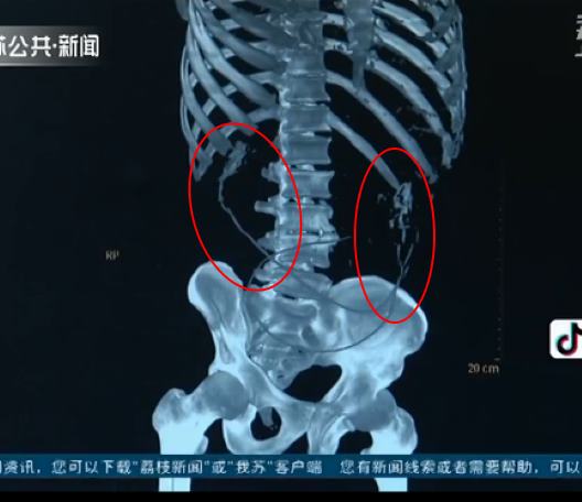 Китаец проглотил живьем двух угрей, чтобы вылечить запор, и они прогрызли ему кишечник