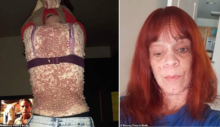 «Меня оскорбляют и считают заразной»: Женщина с тысячами опухолей на теле боится лишний раз пройти по улице