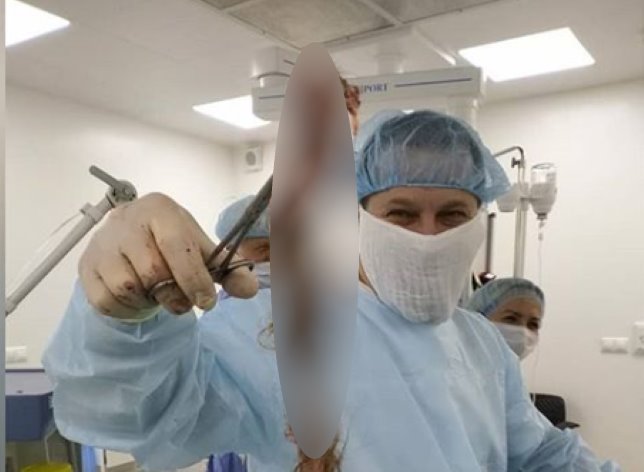 Из тела россиянки удалили опухоль яичника, забитую выросшими в ней ...волосами