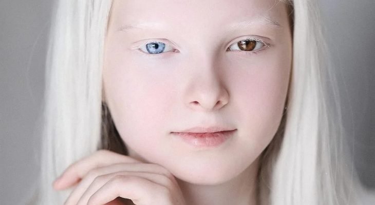 Чеченская девочка-альбинос с разными глазами поразила Сеть необычной красотой