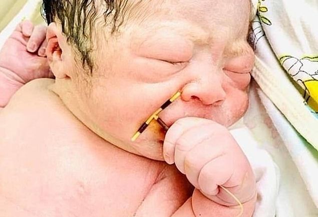 Младенец родился с противозачаточной спиралью