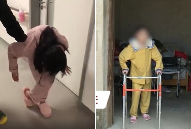 В Китае разогнули девушку, которая 10 лет ходила сложенной пополам